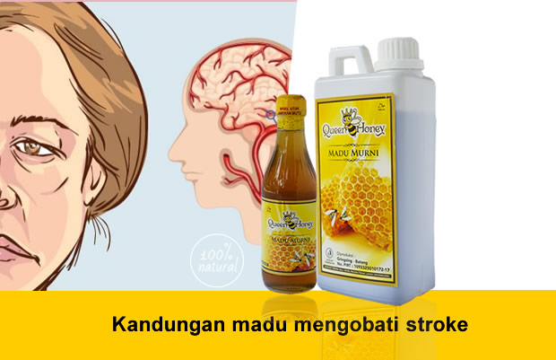 Kandungan madu mengobati stroke