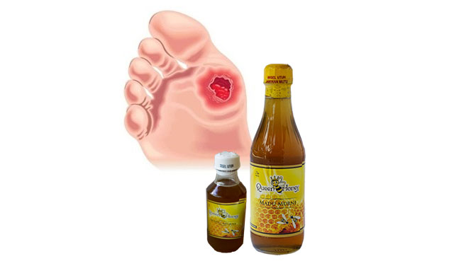 Madu Queen Honey sebagai obat luka